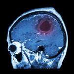 Traumatic Brain Injures